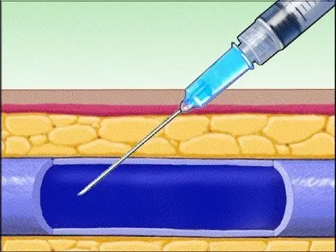 Injecție intravenoasă