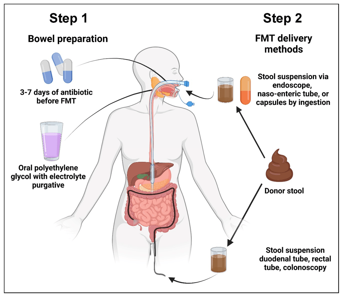 Cele două etape ale unui transplant de microbiotică fecală: pregătirea intestinală și căile de administrare a FMT